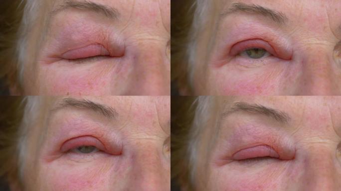 特写镜头，dop: 一名衰老的白人妇女发痒的眼睛肿胀的详细照片。