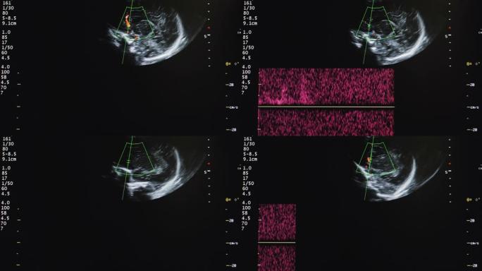 新生儿心脏的超声波。
