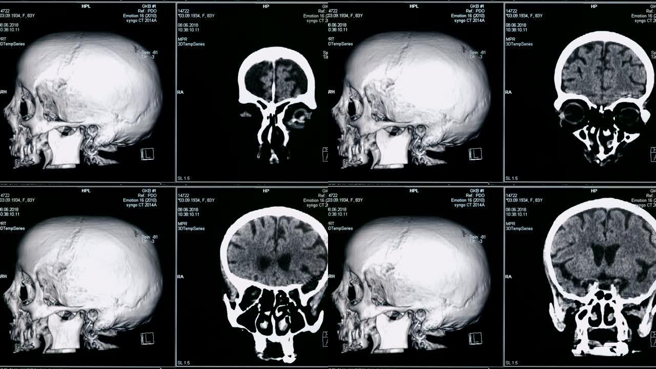 大脑的3D扫描，特写。特殊设备在诊所扫描病人的大脑。