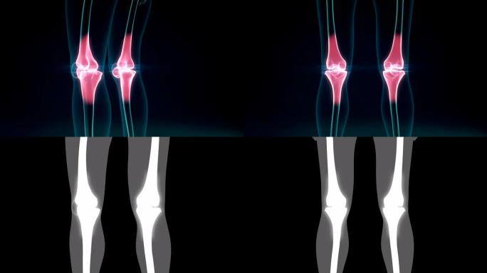 膝关节疼痛关节炎。健康关节和不健康疼痛关节与骨关节炎。4 k.2。