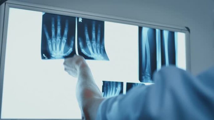 医生在医院检查手部x射线图像
