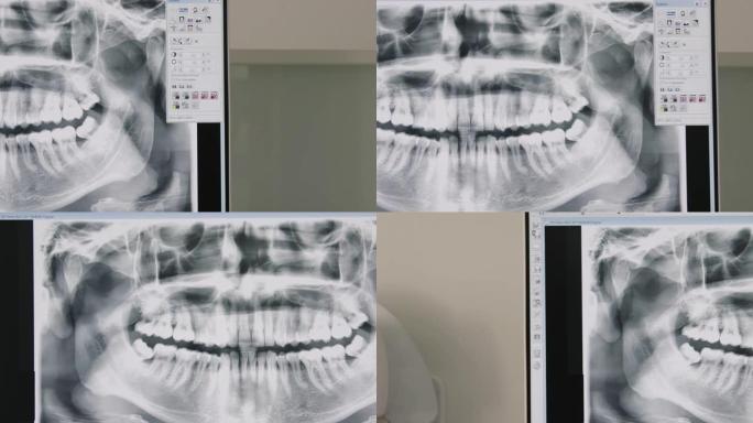 人牙x射线图像在屏幕上的特写