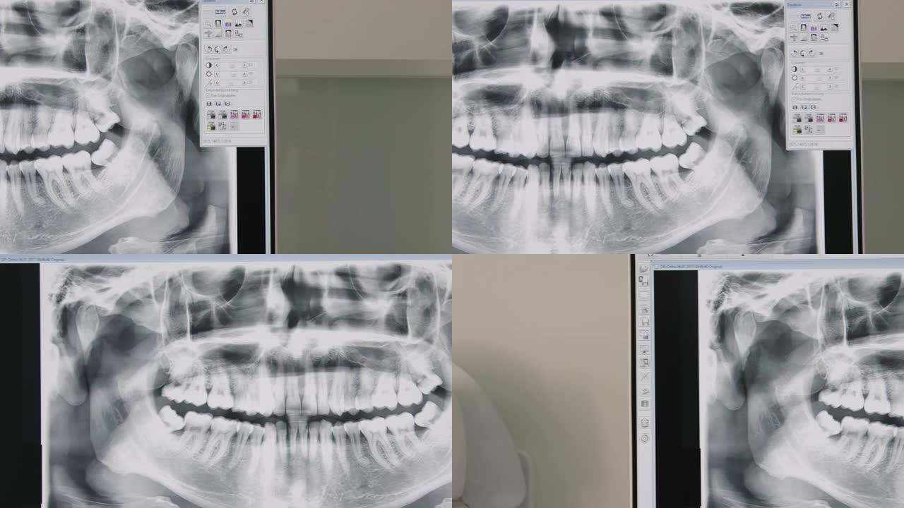 人牙x射线图像在屏幕上的特写
