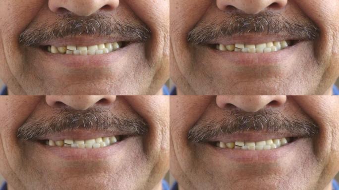 牙齿参差不齐的人微笑着。一个成熟的成年男性在牙科治疗前的证据，他的牙齿变白并获得牙套以使其变直。牙齿