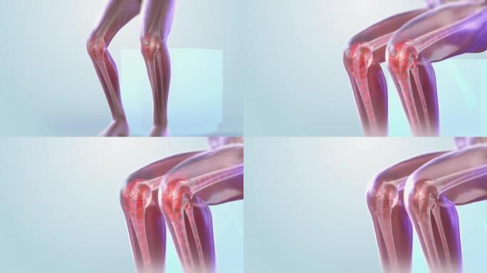 VFX关节和膝盖疼痛虚拟现实演示渲染。因腿部创伤或关节炎而感到不适的人。示意性医学可视化。