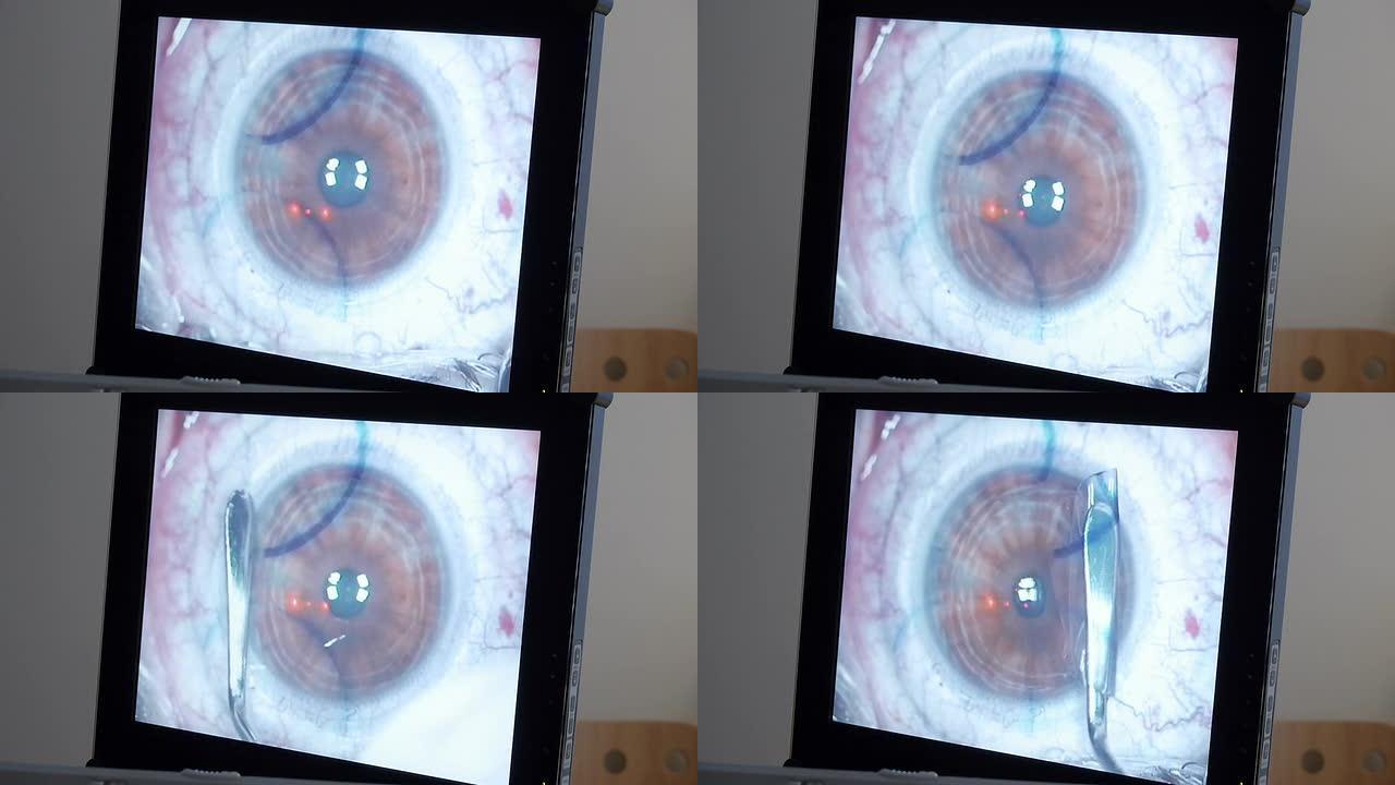 宏观: 激光眼科手术，第4步