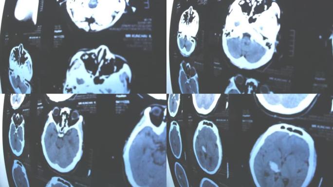 阿尔茨海默氏症的x射线，大脑问题