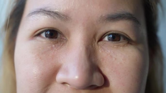 女性面部汗管瘤或milia milium囊肿或脂溢性角化病