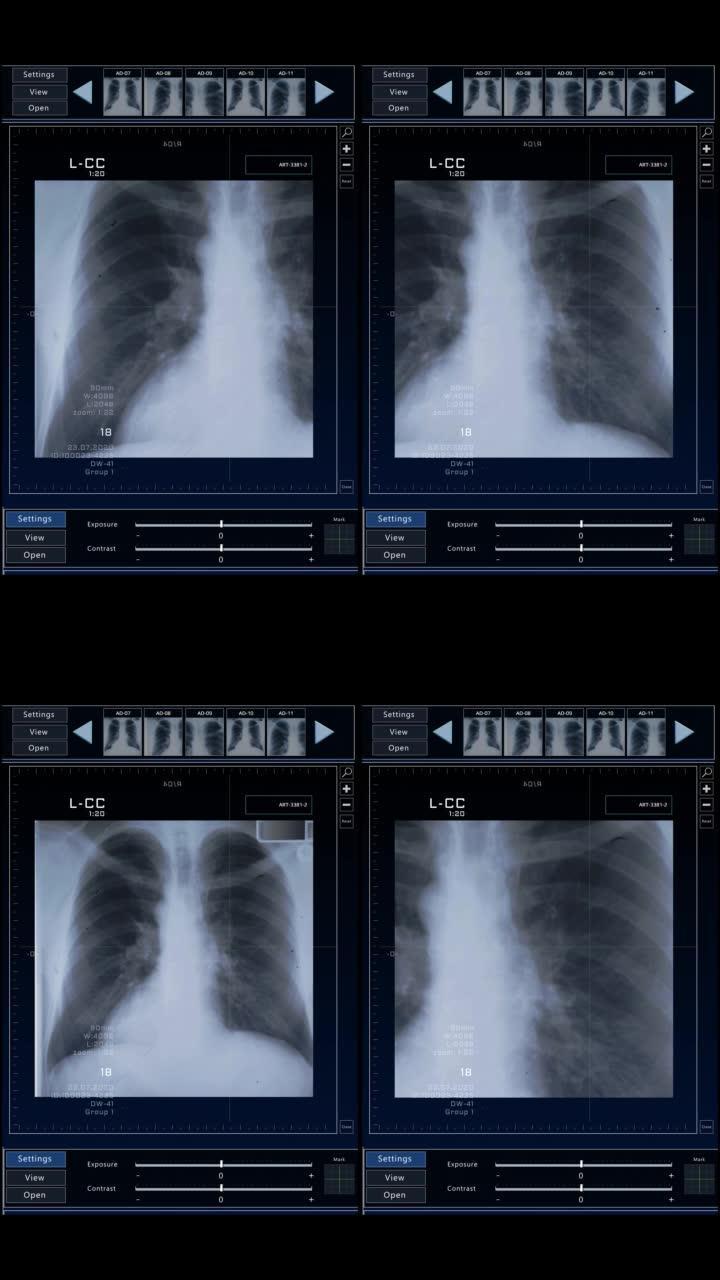 垂直屏幕: 计算机断层扫描胸部扫描模型，具有多个窗口和数据。具有计算机显示器和笔记本电脑屏幕ct扫描