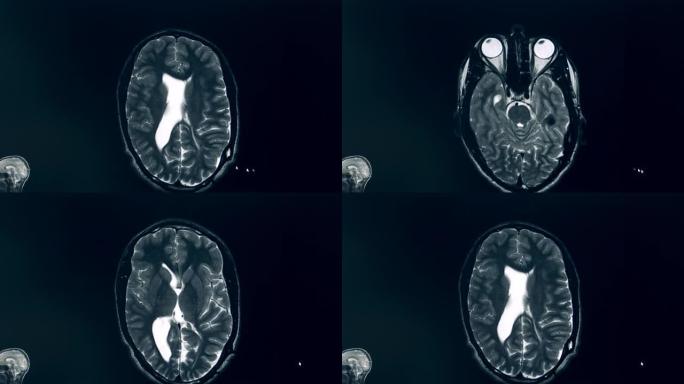 MRI过程中大脑的计算机图像
