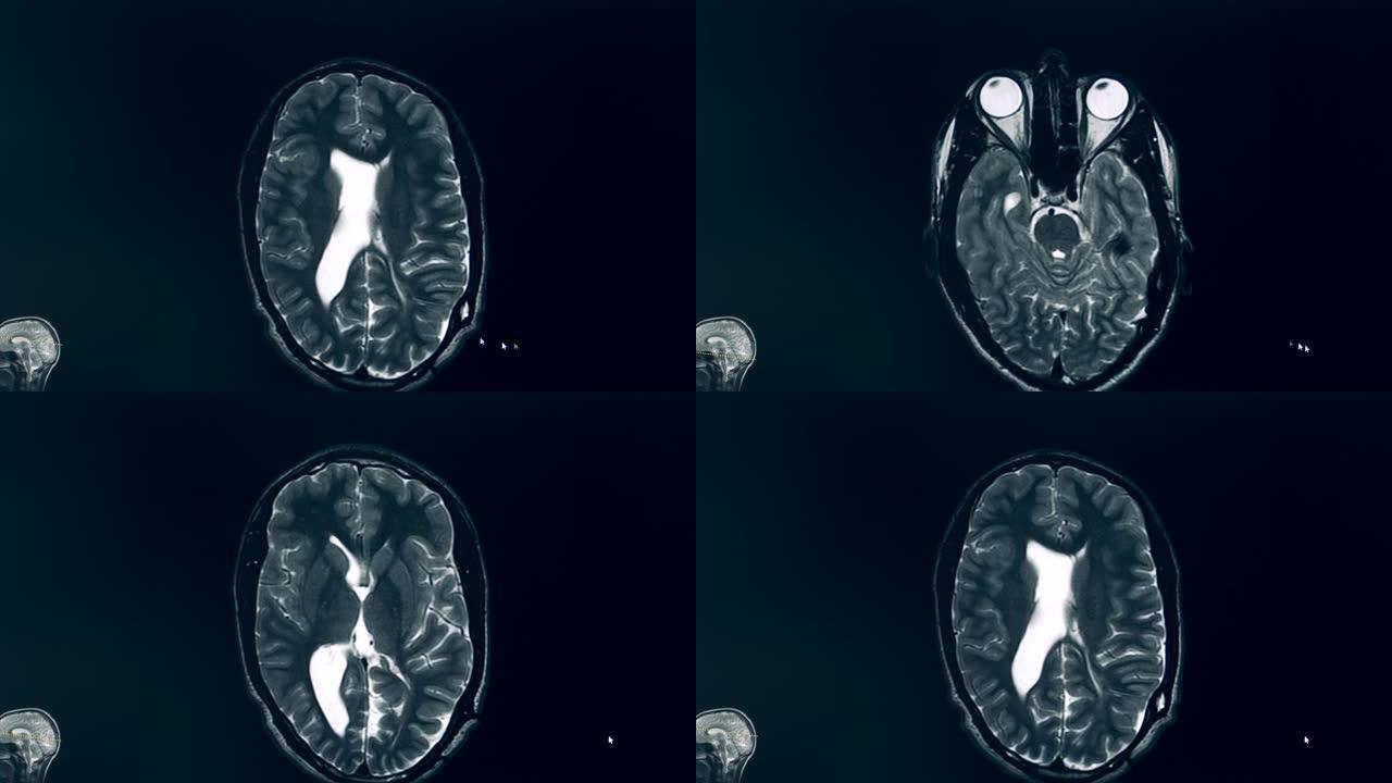 MRI过程中大脑的计算机图像