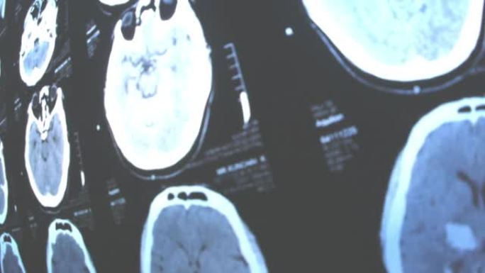 阿尔茨海默氏症的x射线，大脑问题
