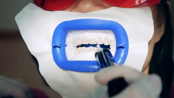 对患者进行的牙齿漂白程序