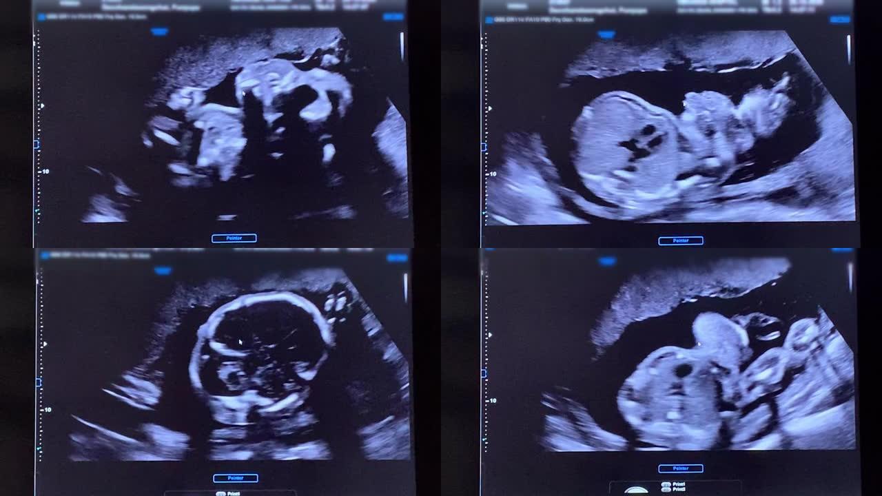 怀孕婴儿的超声扫描。