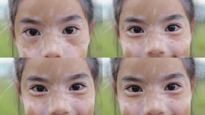 小孩儿可爱的亚洲女孩与美丽的白癜风皮肤和头发。
