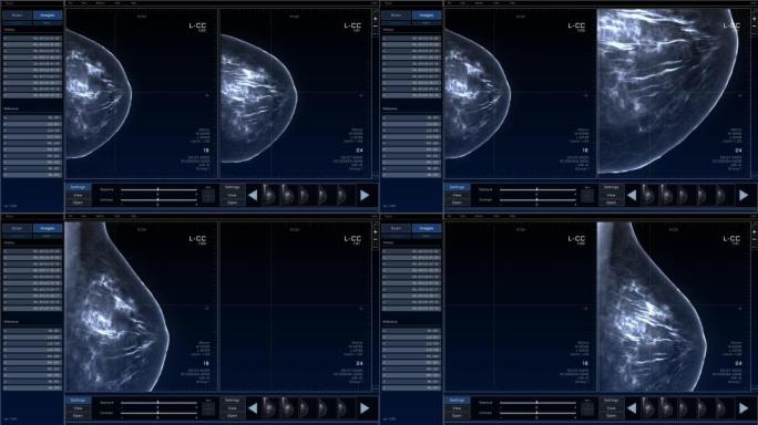 乳房x线照片乳房扫描模型，具有多个窗口和数据。具有x射线扫描结果的医学研究环境软件，用于计算机显示器