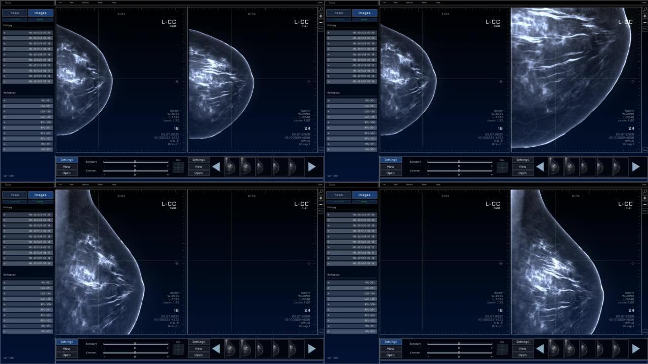 乳房x线照片乳房扫描模型，具有多个窗口和数据。具有x射线扫描结果的医学研究环境软件，用于计算机显示器
