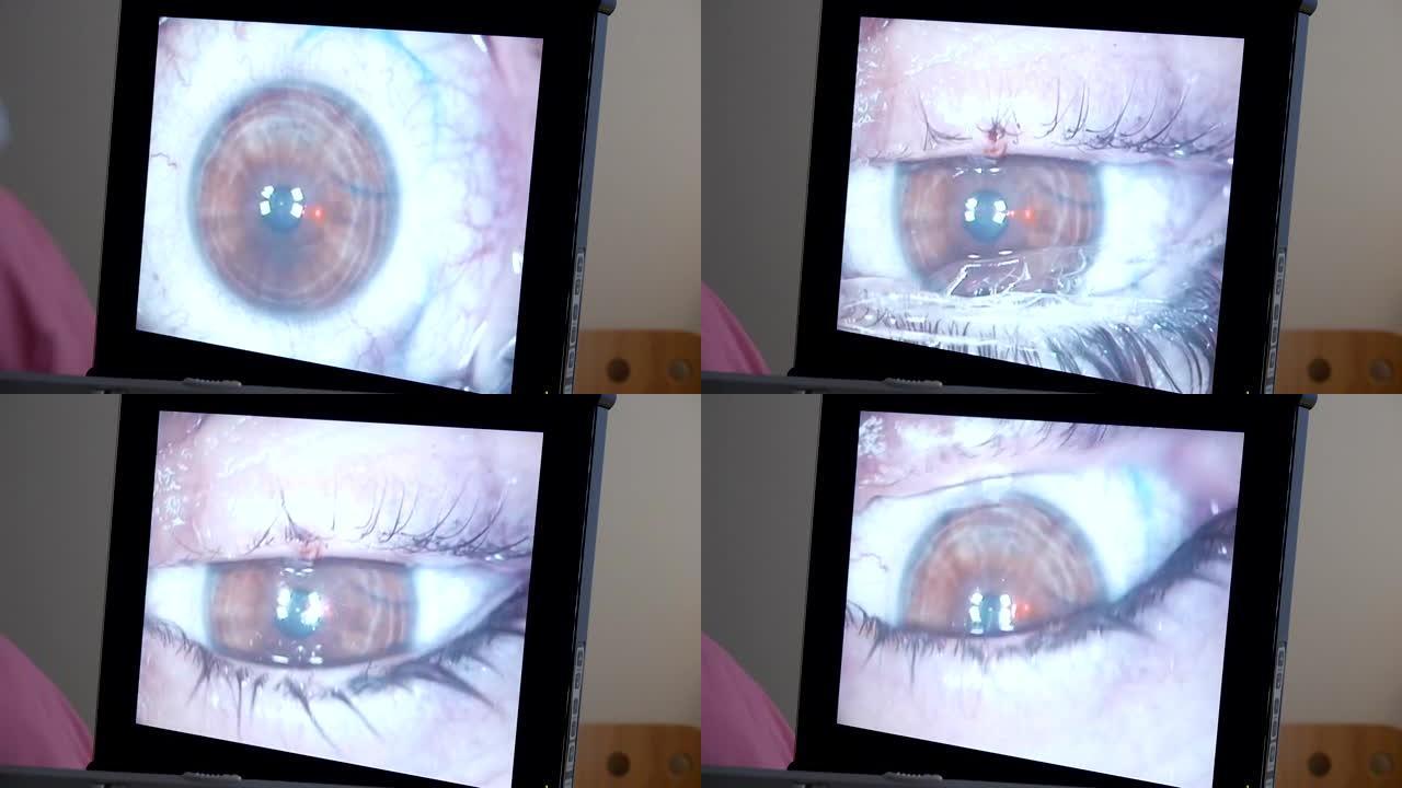 宏观: 激光眼科手术，第6步