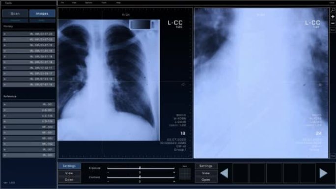 具有多个窗口和数据的计算机断层扫描胸部扫描模型。具有计算机显示器和笔记本电脑屏幕ct扫描结果的医学研