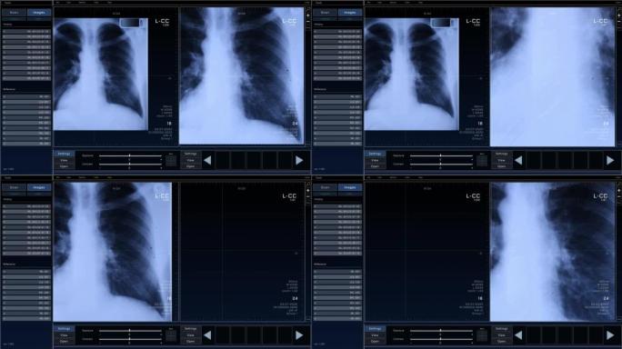 具有多个窗口和数据的计算机断层扫描胸部扫描模型。具有计算机显示器和笔记本电脑屏幕ct扫描结果的医学研