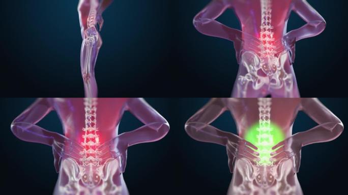 VFX背痛虚拟现实演示渲染。因脊柱创伤或关节炎而感到不适的人。示意性医学可视化。