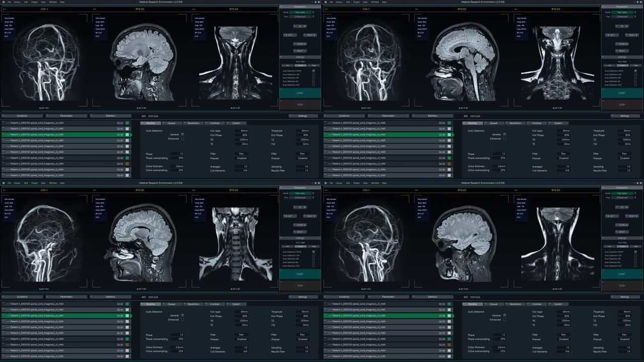 显示大脑磁共振图像扫描实时过程的医疗软件界面。真实的MRI有助于诊断神经系统疾病，肿瘤，损伤，中风，