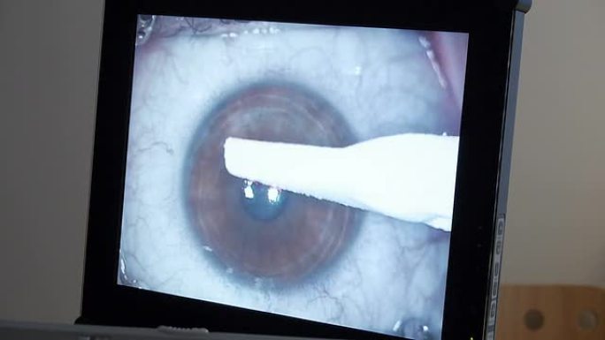 宏观: 激光眼科手术，第1步