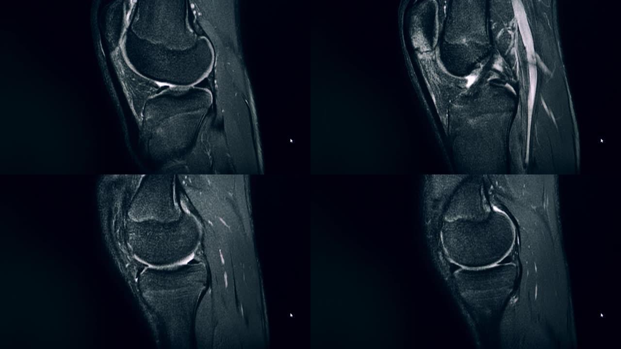 膝关节正在MRI扫描中显示
