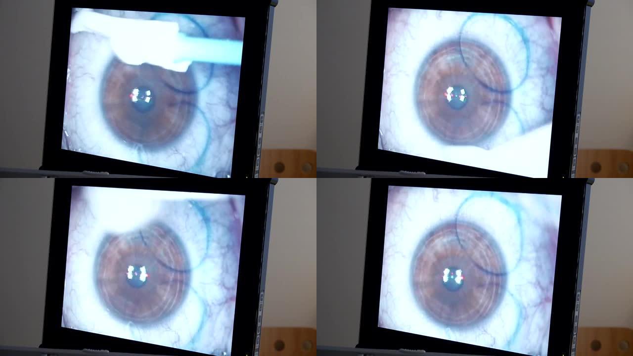 宏观: 激光眼科手术，第二步