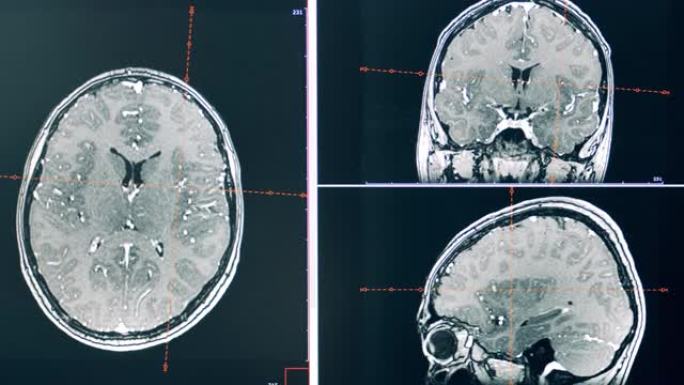 人脑动态ct扫描