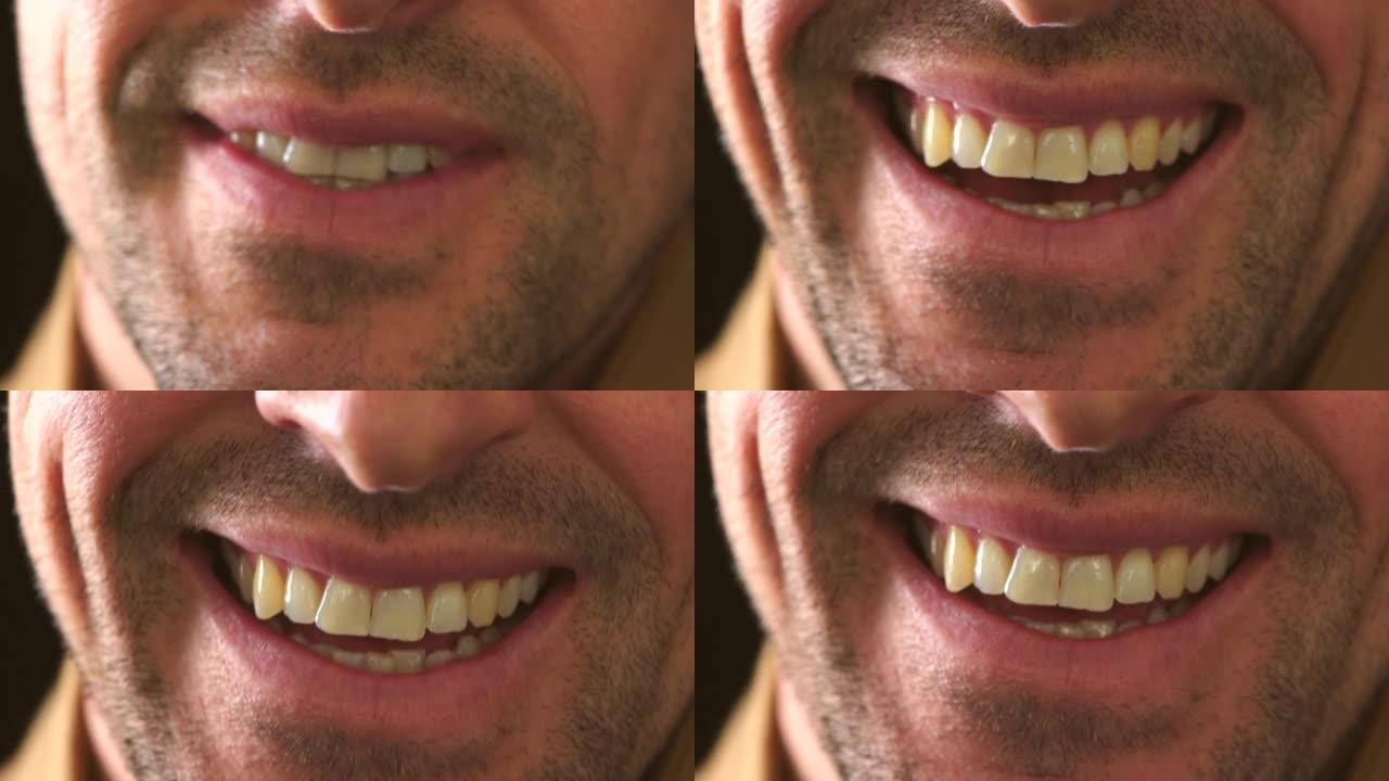 黄色牙齿和面部毛发的笑人的口腔特写。一个快乐微笑的男性面部细节的头像，下巴和脸颊没有剃光，在牙医那里