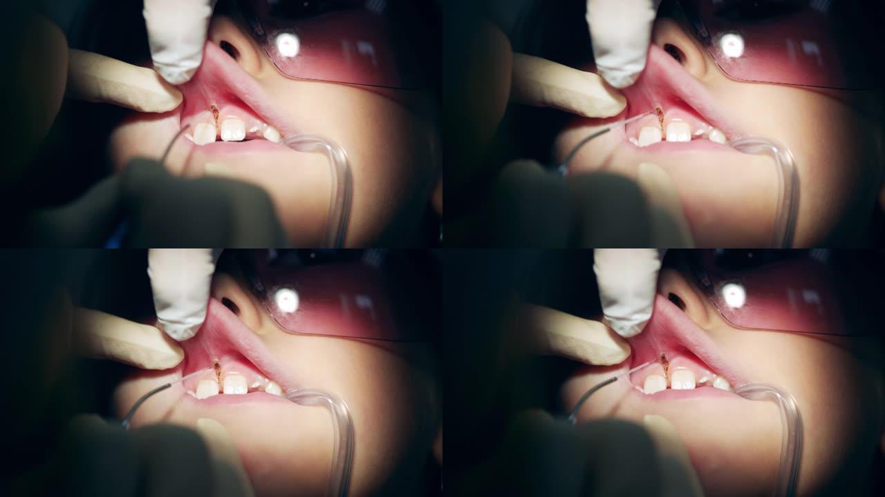 牙医修复女性牙龈的特写