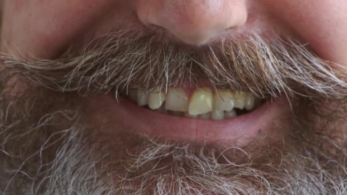 需要正畸修复和牙套治疗的不良牙齿和弯曲的门牙的特写。一个微笑着的成熟男人的嘴巴拥挤，牙齿错位，胡须和