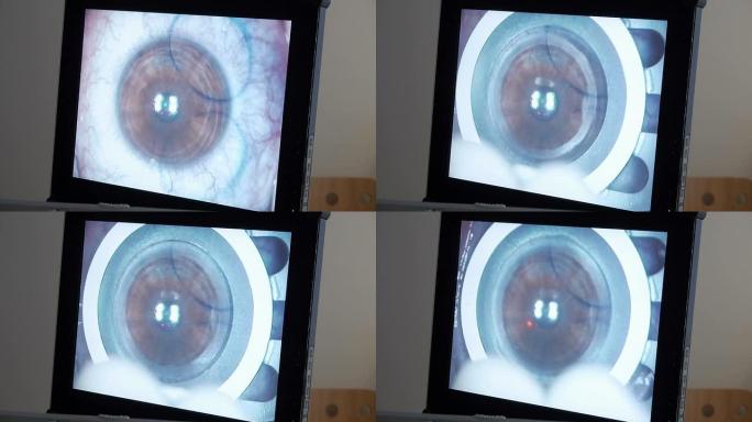 宏观: 激光眼科手术，第3步