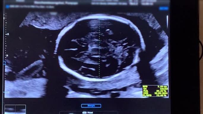 怀孕婴儿的超声扫描。