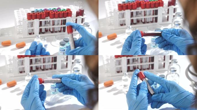 科学家在血液测试中检查冠状病毒COVID 19医学样本