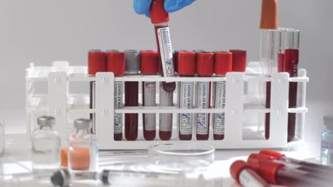 科学家在血液测试中检查冠状病毒COVID 19医学样本