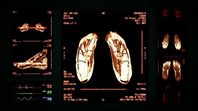 足部MRI扫描。顶部、正面和侧面视图。琥珀。