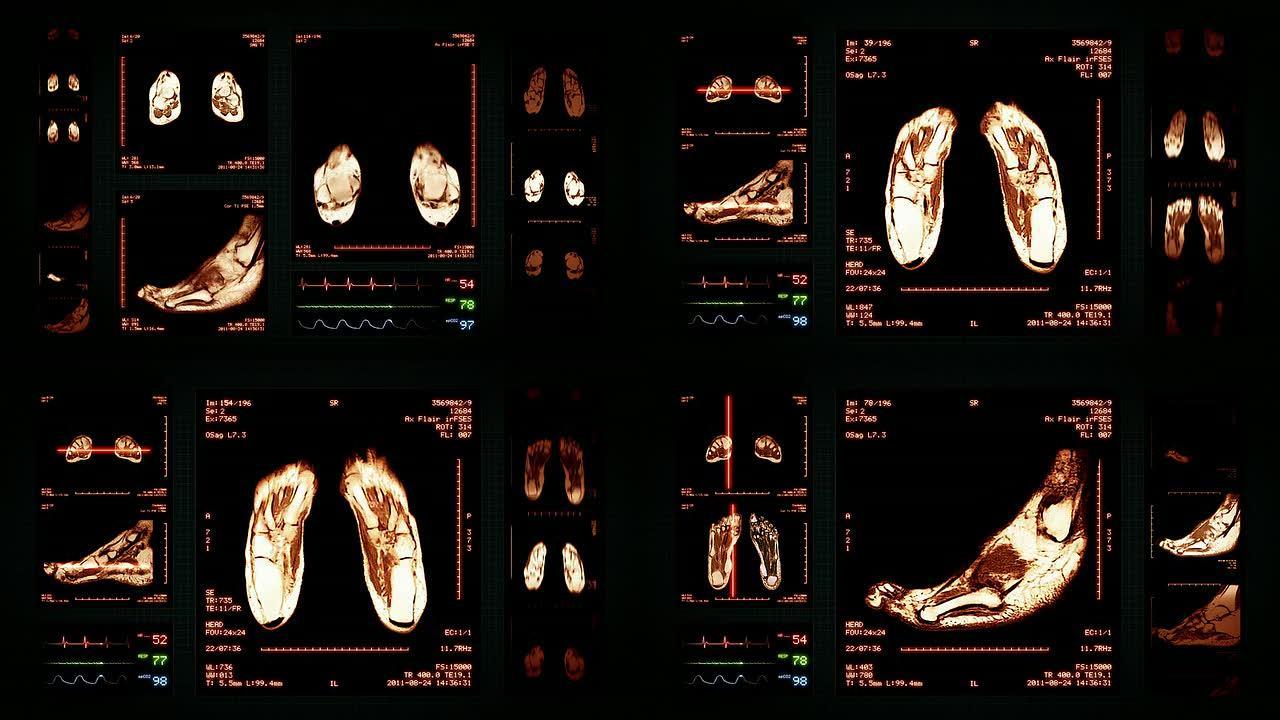 足部MRI扫描。顶部、正面和侧面视图。琥珀。
