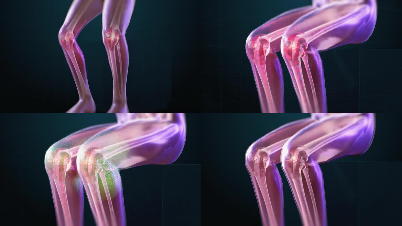 VFX关节和膝盖疼痛虚拟现实演示渲染。因腿部创伤或关节炎而感到不适的人。示意性医学可视化。