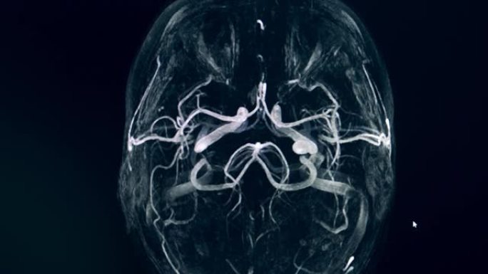 脑动脉环的动态CT图像