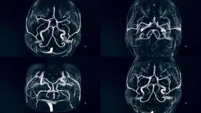 脑动脉环的动态CT图像
