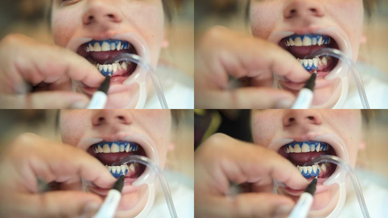 牙医的女人美白牙齿