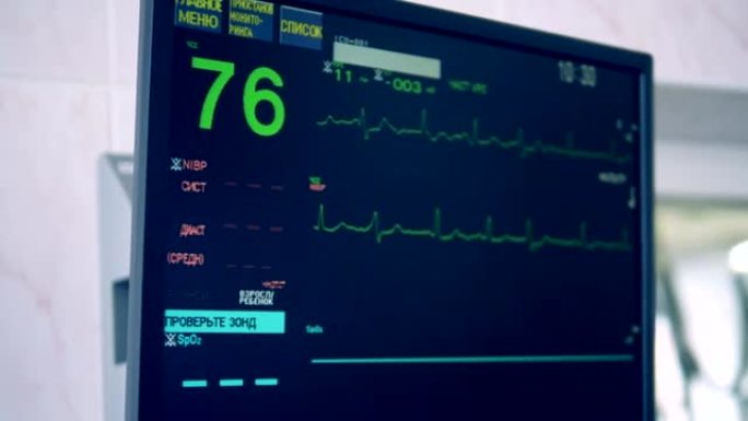 特殊监视器显示手术期间心脏的状况。4K。