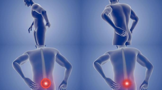 背部疼痛或受伤3D成人男性医疗