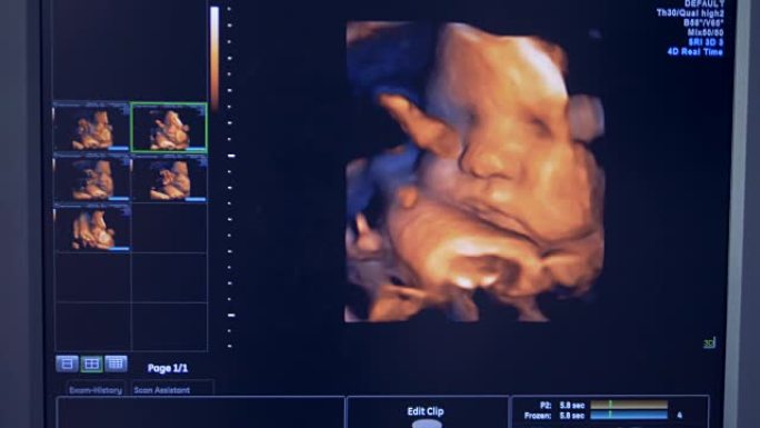 超声波监护仪上婴儿的脸部特写