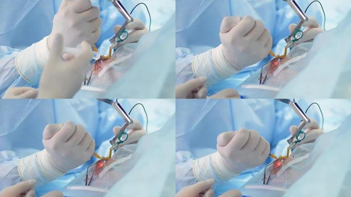 眼睛手术过程中使用注射器的助手手的特写镜头。