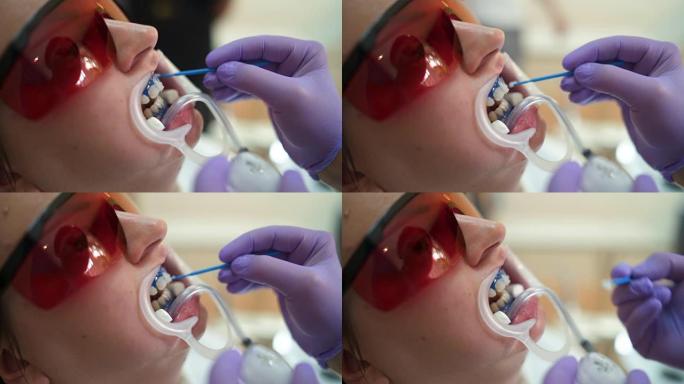 牙医的女人美白牙齿