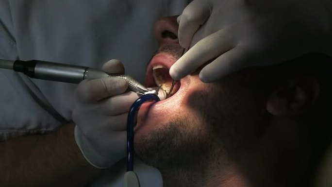 牙医在工作洗牙牙结石医院