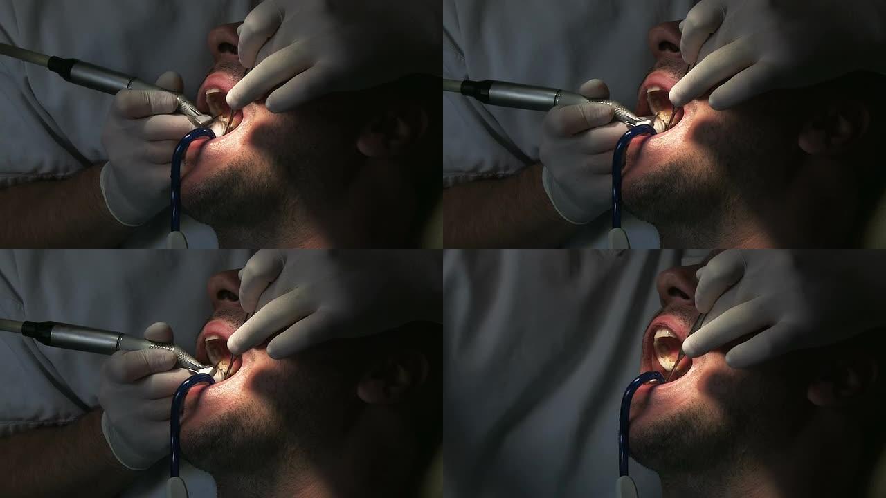 牙医在工作洗牙牙结石医院